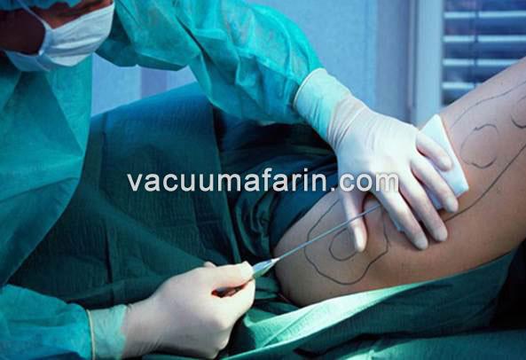 خرید پمپ لیپوساکشن خرید پمپ لیپوساکشن